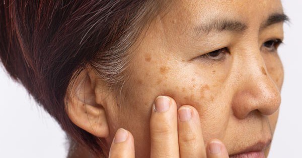 Ngoài việc uống thuốc hoặc sinh tố, còn có cách nào khác để trị nám da không?
