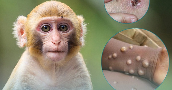 thumbnail - Bệnh đậu mùa khỉ: Các khuyến cáo giảm nguy cơ lây bệnh