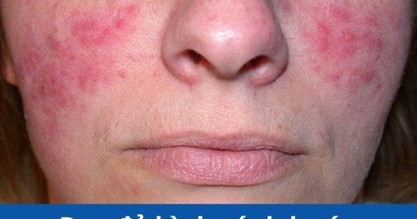 thumbnail - Bệnh lupus ban đỏ và cách hỗ trợ giảm nguy cơ tiến triển từ thảo dược