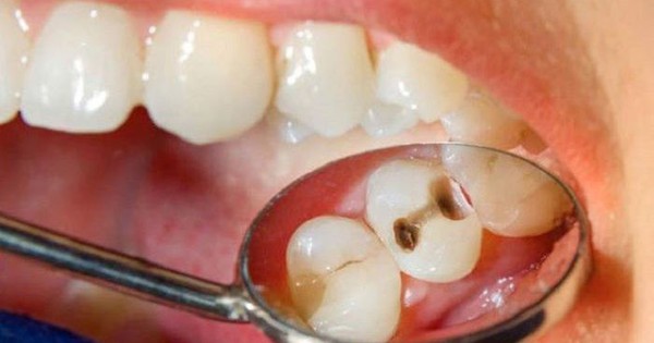 Những loại thuốc nào được sử dụng để điều trị sâu răng?
