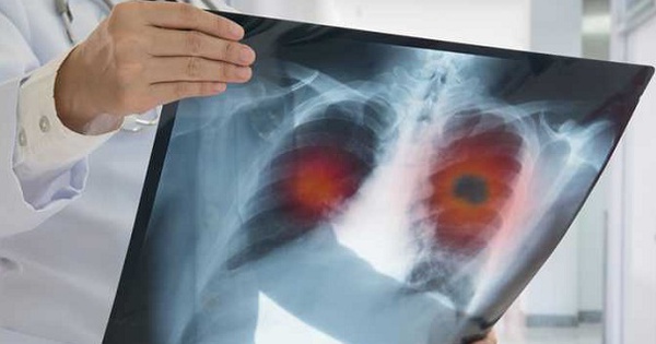 Điều gì gây ra ung thư phổi?
