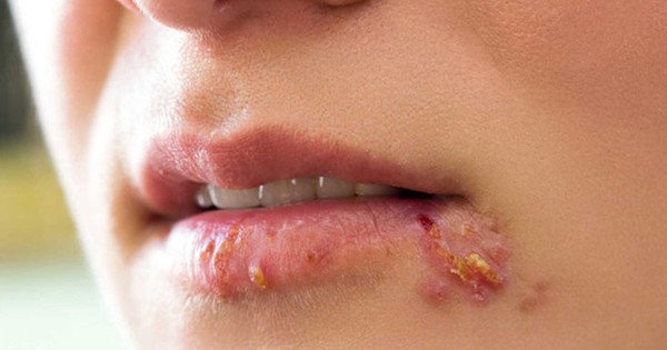Mụn ở rìa môi có gây đau và khó khăn khi ăn uống không?
