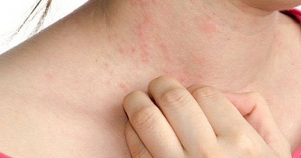 Các loại bệnh ngoài da và cách phòng chống bạn nên biết