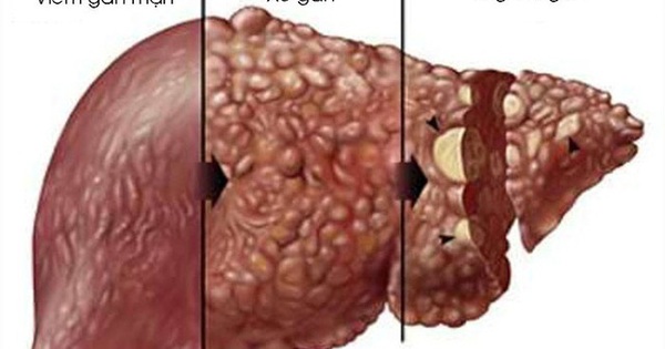 Có nên uống rượu bia nhiều có bị viêm gan b không và những thông tin quan trọng