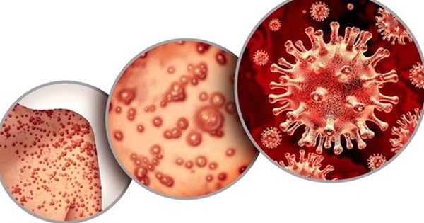 Bệnh đậu mùa có liên quan tới vi-rút corona không?
