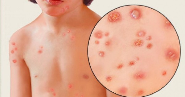 Có những biện pháp phòng tránh nhiễm trùng da nào?
