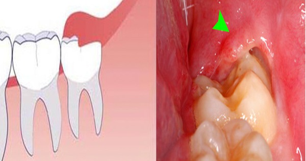 Có cách nào để giảm hiện tượng đau và sưng khi răng khôn mọc?
