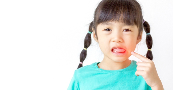 Cách  chăm sóc miệng cho trẻ bị lở miệng mà bạn cần biết