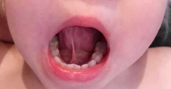 Tongue-tie/Ankyloglossia là gì? 
