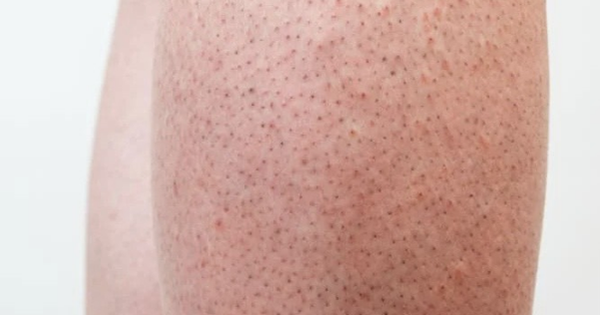 Các phương pháp điều trị bệnh viêm lỗ chân lông là gì?