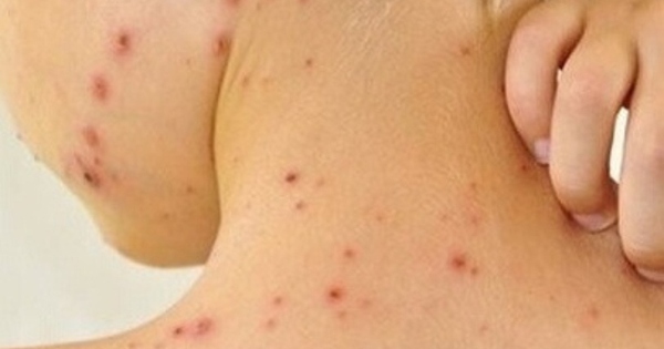 Bệnh ghẻ ruồi lây nhiễm qua cách nào?

