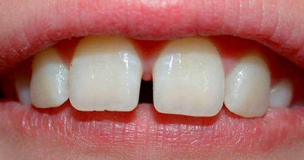Khi nào cần khám nha khoa để khắc phục răng thưa?
