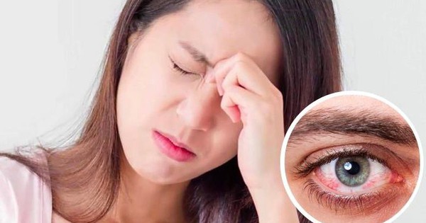 Có phương pháp điều trị nào hiệu quả cho bệnh đau mắt đỏ?