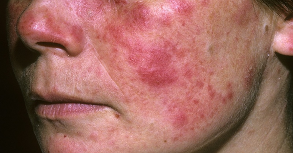 Bệnh lupus ban đỏ ảnh hưởng đến cơ thể như thế nào?

