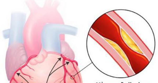 Những nguyên tắc phòng tránh bệnh mạch vành là gì?
