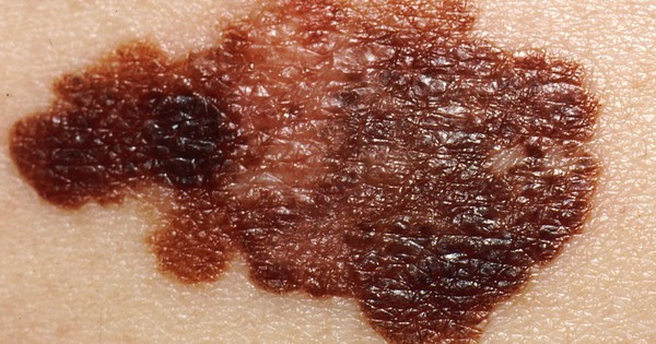 Tác động của ung thư sắc tố da đến sức khỏe và cuộc sống của người bị?
