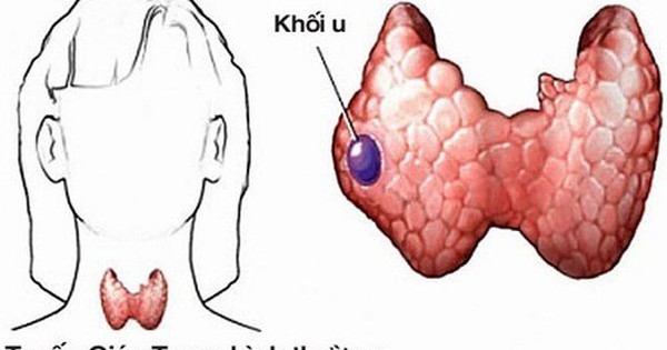 Bệnh nhân ung thư tuyến giáp nên tránh ăn các chế phẩm từ đậu nành vì lí do gì?
