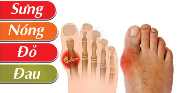 Người bệnh gout ăn gì ngày Tết để tránh cơn đau bùng phát?