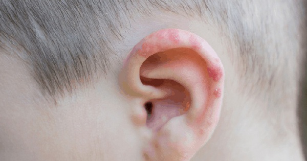 Mụn ở vùng vành tai có liên quan đến tình trạng bã nhờn và tế bào chết không?
