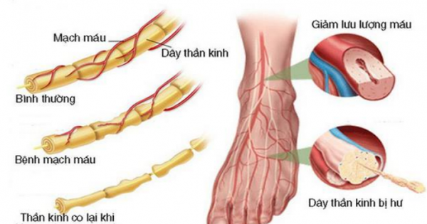 Ưu điểm và nhược điểm của thuốc gabapentin (Neurontin) trong việc điều trị biến chứng thần kinh tiểu đường là gì?
