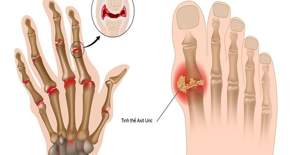 6 cách giảm acid uric máu liên quan đến bệnh gout
