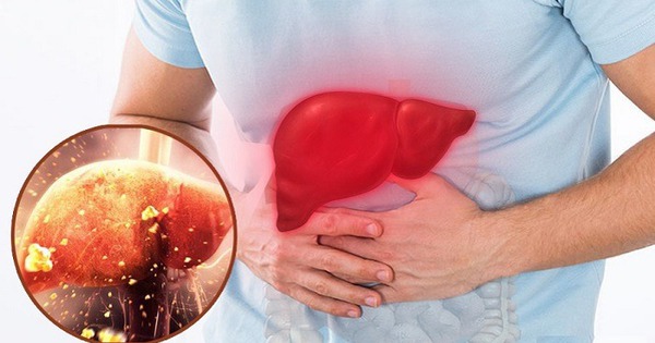 Điểm mặt những thực phẩm tồi tệ nhất cho sức khỏe lá gan