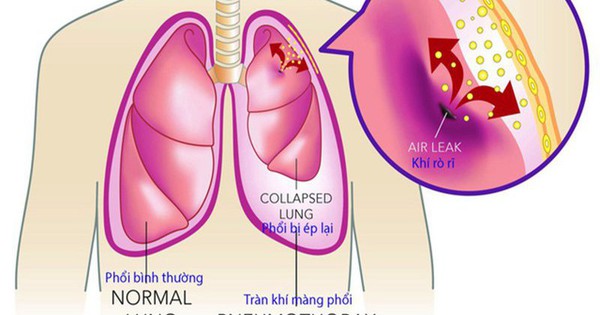 Kén khí phổi là gì và nguyên nhân gây ra bệnh?
