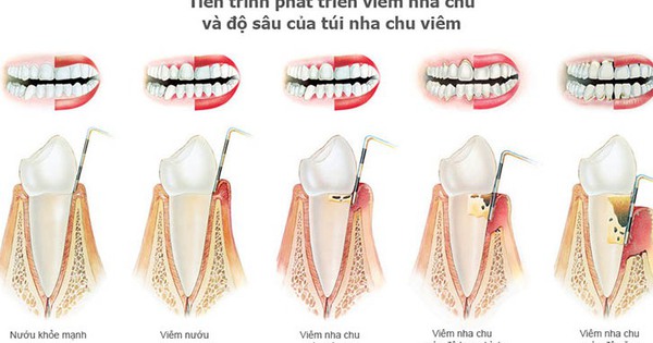 Có những phương pháp điều trị nào cho viêm nha chu nặng?
