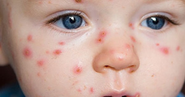 Khi trẻ bị nhiễm virus thủy đậu, cơ thể sẽ có những biểu hiện gì?
