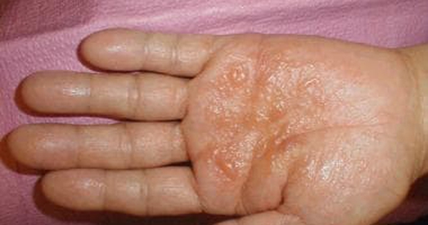 Chàm tổ đỉa có liên quan đến eczema không?
