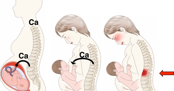 Loãng xương sau sinh: Nguyên nhân, biểu hiện và cách phòng ngừa
