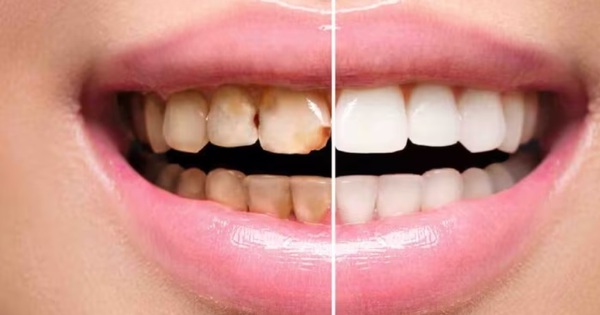 Rủi ro và ảnh hưởng của việc sử dụng hàm răng vàng?
