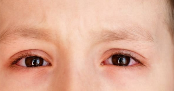 Đau mắt đỏ có thể là triệu chứng chính của Covid-19 hay chỉ là triệu chứng bổ trợ?
