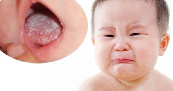 Nấm miệng ở trẻ em có thể lây lan hay không?
