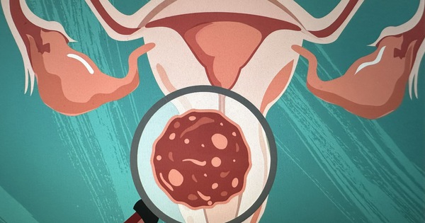 Làm thế nào để phòng ngừa và giảm nguy cơ mắc ung thư cổ tử cung?