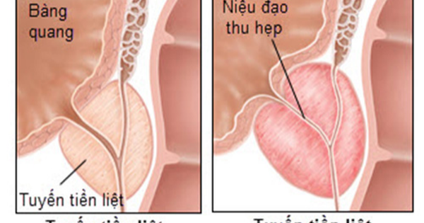 Dùng thuốc trị viêm tuyến tiền liệt có tác dụng phụ không?
