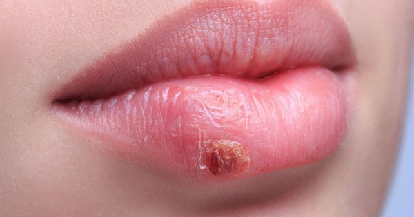 Virus gây herpes có thể diễn biến như thế nào?
