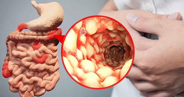 Bài giảng bệnh Crohn sẽ tập trung vào những vấn đề gì? 
