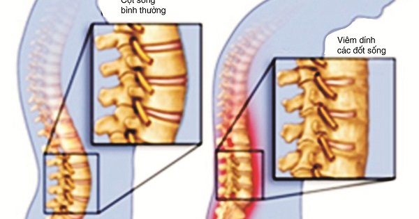 Tiêm thuốc sinh học là phương pháp điều trị hiệu quả nhất cho viêm cột sống dính khớp hay không?
