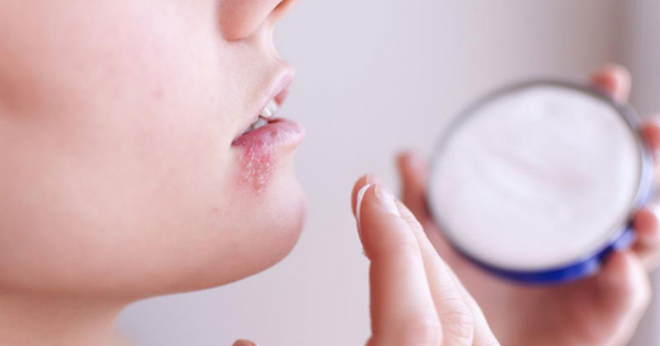 Có những cách nào để chữa trị viêm da dạng Herpes? 
