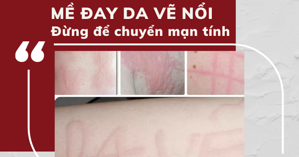 Bệnh mề đay vẽ da nổi là một loại bệnh của da phổ biến như thế nào?
