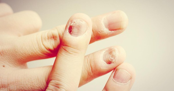 Trong trường hợp không đạt được hiệu quả từ thuốc trị nấm móng tay, có những biện pháp và phương pháp thay thế nào bạn có thể khuyên dùng?
