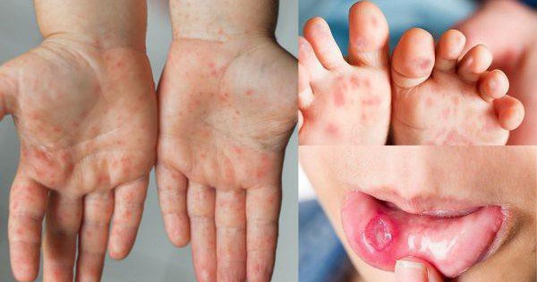 Trẻ em có nên đi học khi bị bệnh tay chân miệng?
