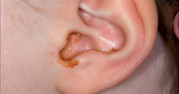Viêm tai giữa có thể gây nhói và giật giật ở tai như thế nào?
