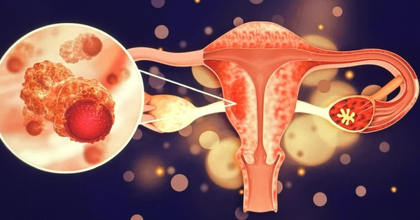 Cách điều trị ung thư buồng trứng bằng hormone thay thế?
