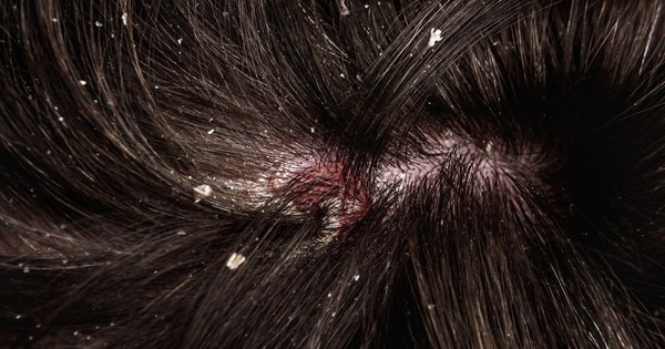 Nếu nghi ngờ bị nấm da đầu, cần đi khám cho chính xác không?