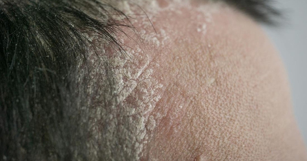 Những nguyên tắc cần tuân theo sau khi trị nấm da đầu nặng để ngăn tái phát?
