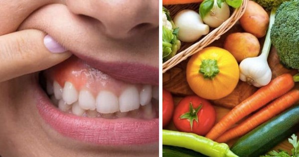 Chế độ dinh dưỡng cho người viêm nướu răng