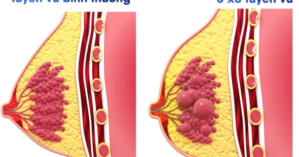 U xơ tuyến v&#250; c&#243; dẫn đến ung thư v&#250; kh&#244;ng?