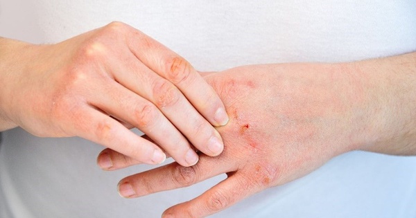 Khắc phục da tay khô trong mùa đông